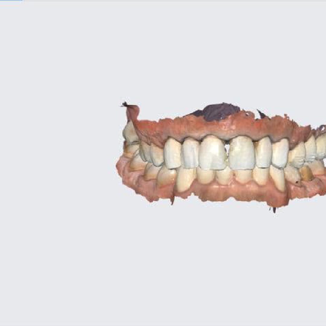 Ψηφιακό 3D scan άνω και κάτω γνάθου με σύγκλειση – Digital Workflow Stratos Lab